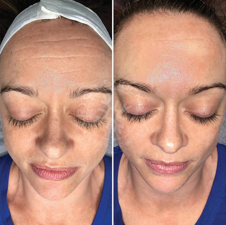 Cryo Fat Reduction Toning Before and After Bradenton, FL