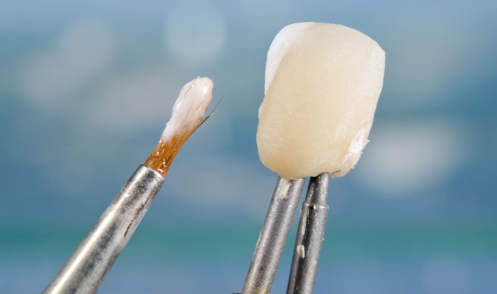 Veneers Hattiesburg, MS