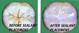 sealants