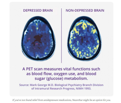 PET scans comparing depressed and non-depressed brains, showing darker vs brighter activity patterns