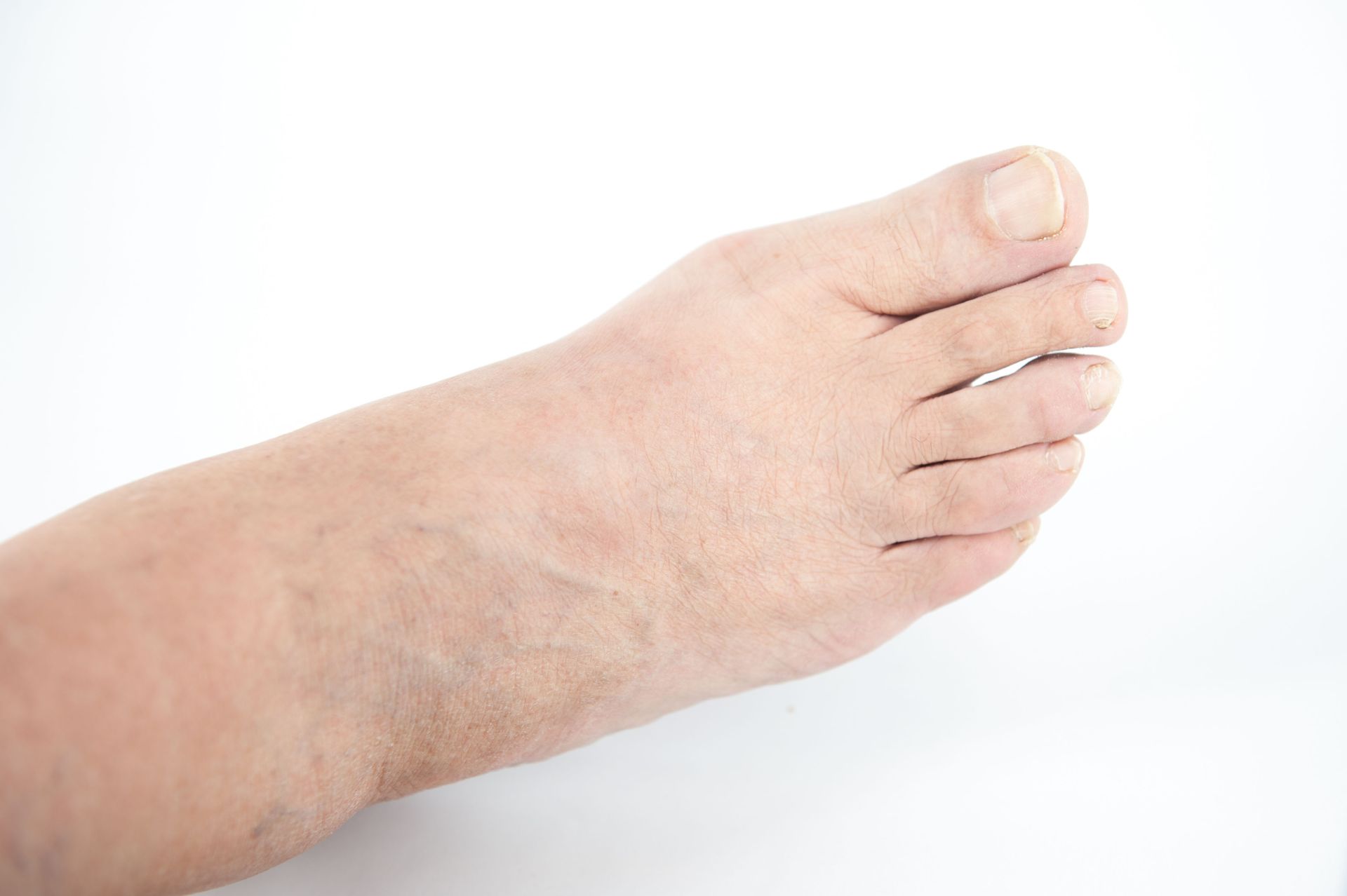 Gouges On Foot Podiatrists | Grand Island, NE | Mid Nebraska Foot Clinic