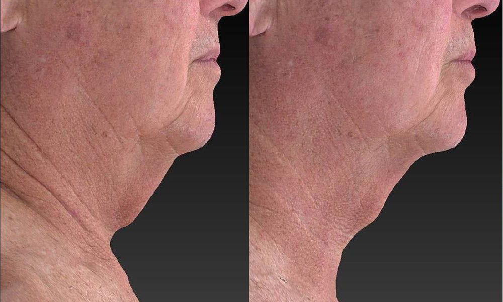 UltraSlim® Before and After Photos Verona Spine & Wellness