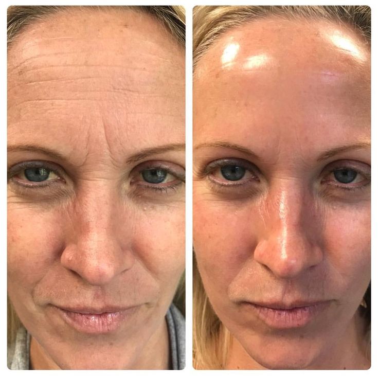 HydroFacial | Skin Care | Lake In The Hills, IL