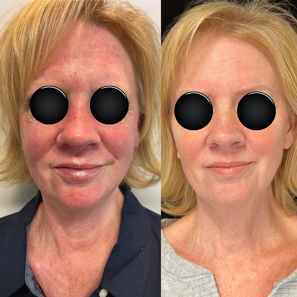 Body Contouring Near Me Fishkill, NY