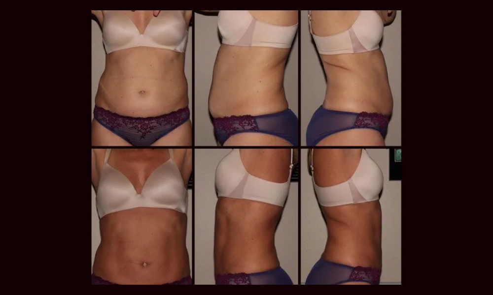 Before-and-after collage of torso photos showing slimmer waist and abdomen in beige top and purple underwear