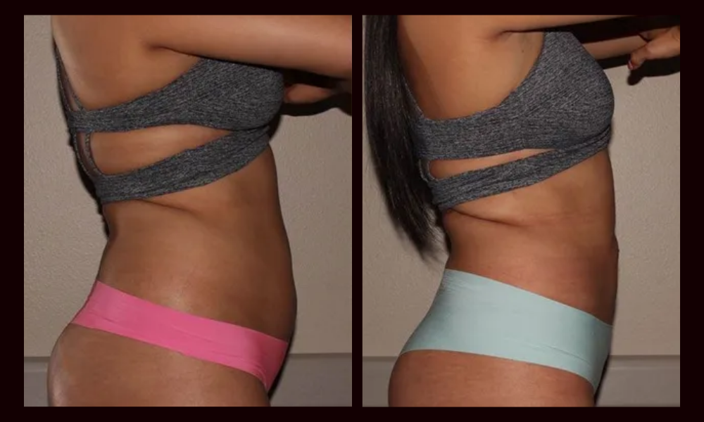 Side-by-side side profiles of a person in underwear and a gray top, showing before-and-after body shape comparison.