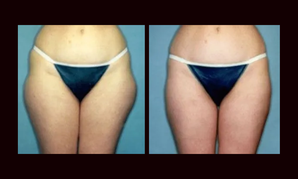 Side-by-side view of a person’s torso and hips in dark underwear, front and back comparison