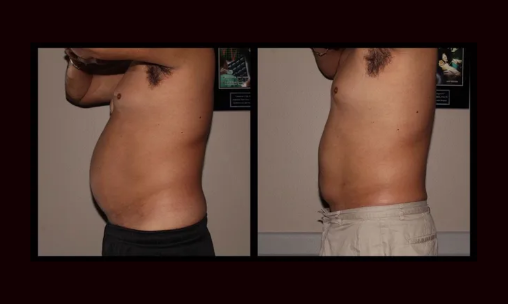 Side-by-side torso profile photos showing a larger belly before and a flatter abdomen after.