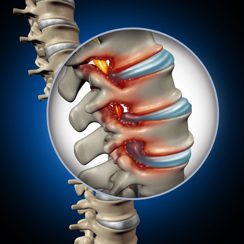 Spinal Spinal Compression Care Holton, KS