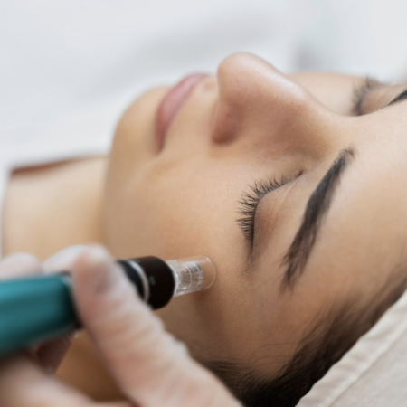 Woman receiving microneedling treatment on her face, lying down with eyes closed, a tool near her cheek.